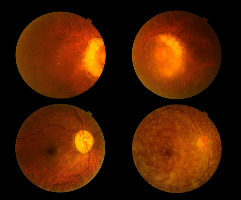 Retina prilikom pregleda zadnjeg dela oka